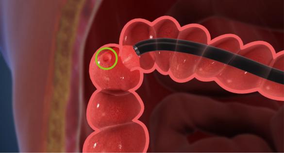 Most colon cancers start as a growth on the inner lining of the colon or rectum.